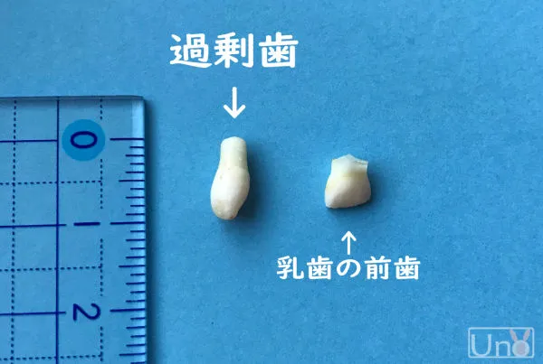 過剰歯の画像