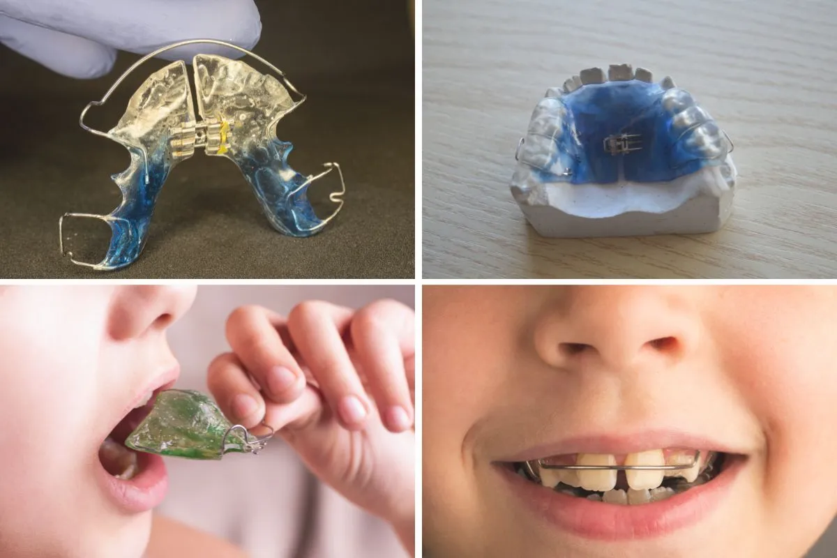 小児歯科矯正　プレート（床矯正装置）の画像