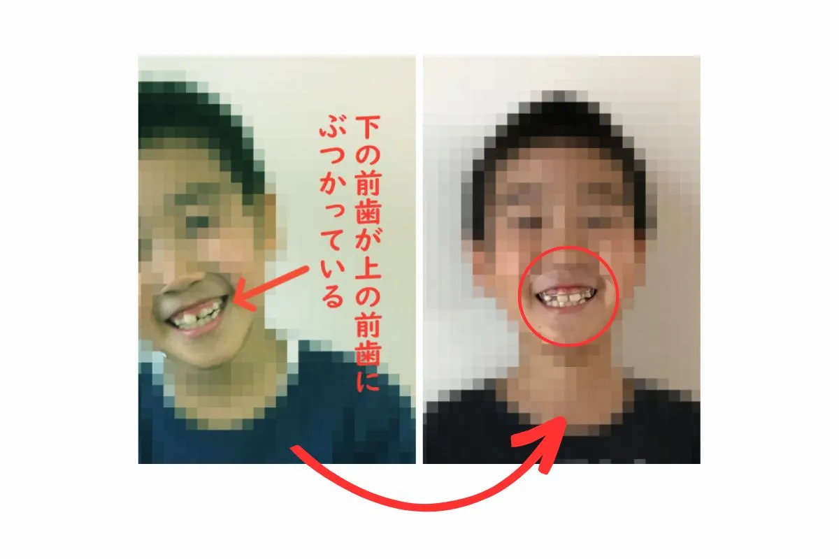 小児歯科矯正　切端咬合治療　小児歯科矯正　プレート（床矯正装置）の画像